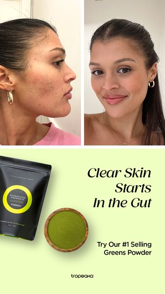 The ad showcases a before-and-after transformation with two photos of a woman. The left photo shows the woman with visible acne on her face, highlighting the skin issues. The right photo presents a clear-skinned woman with a healthy complexion. Below the photos, key marketing messages are displayed. The ad includes a product shot, a black pouch of a green powder with a yellow circle, and a wooden bowl contains the green powder product suggesting the product. The layout is well-structured, with a clear contrast between the before and after. The background is light green.
