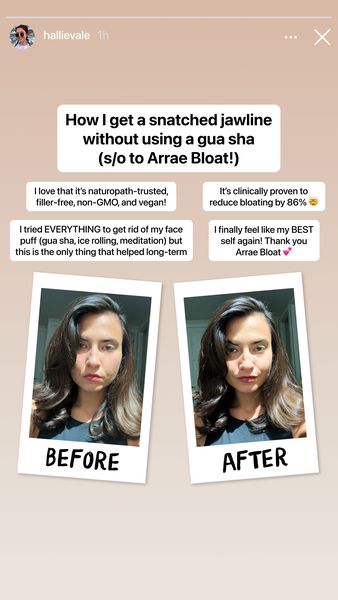 A before-and-after image ad promoting a supplement. The ad is formatted as an Instagram story post. The layout includes a headshot of the same woman in two frames. The 'Before' image shows a slightly puffy face, while the 'After' image shows a more defined jawline. Text overlays highlight the product's benefits and testimonials.